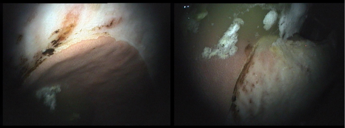 squamous ulceration of the stomach