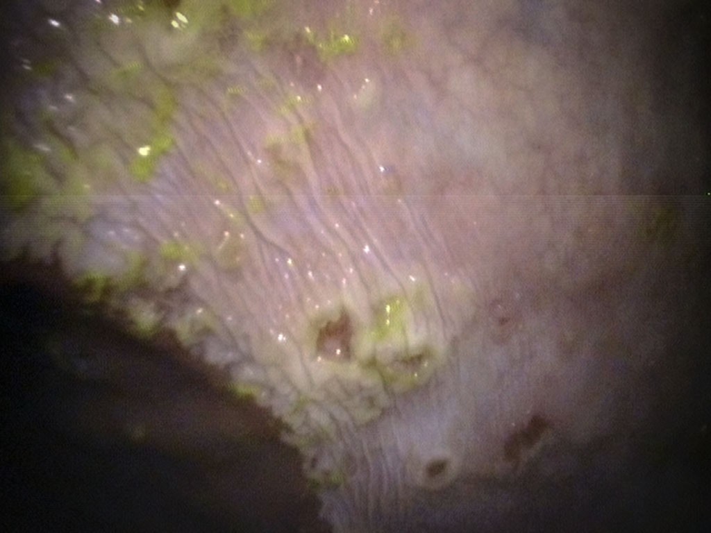 ulcer