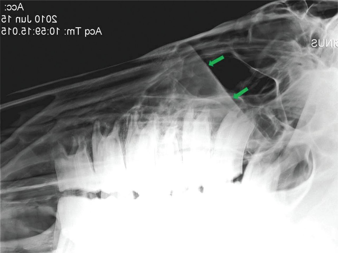 xray-sinusitis