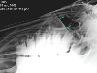 xray-sinusitis